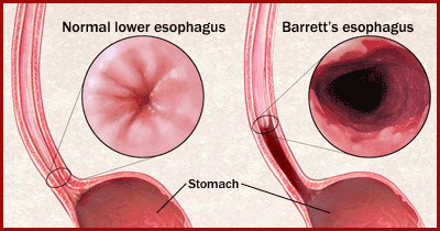 Barrett's esophagus caused by chronic reflux