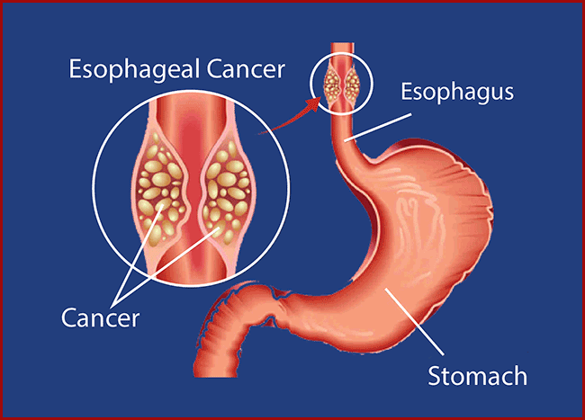 Esophageal cancer risk linked to chronic reflux