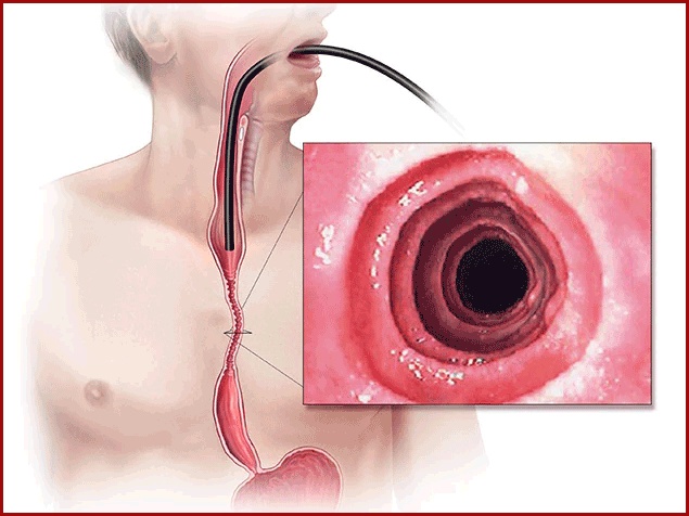 Esophagitis from chronic acid reflux