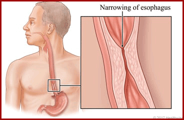 Esophageal stricture narrowing from reflux damage